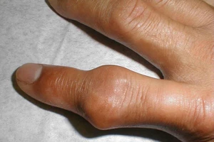 90% người bệnh gút đang lạm dụng thuốc có corticoid