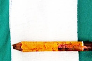 Nô đùa với bạn, bé trai bị bút chì đâm xuyên mông trái