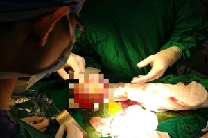 Bụng bé trai 4 tháng phình to vì 'thai trong thai'