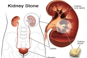 Phòng ngừa sỏi thận, uống bao nhiêu nước là đủ?