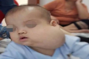 Tìm lại gương mặt cho bé trai mang khối bướu như quả bưởi