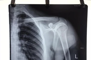 3 giờ vi phẫu nối dây thần kinh cứu cánh tay cho chàng trai