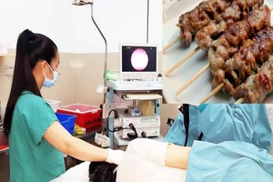 Ăn thịt nướng nuốt luôn xiên que phải vào viện cấp cứu