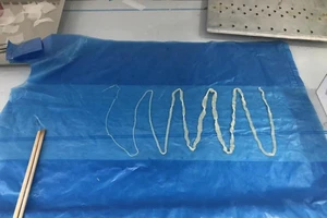 Sán heo dài 2m sống trong ruột người đàn ông 10 năm