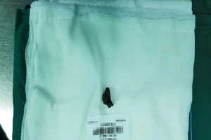 Mảnh đạn 40 năm nằm trong ổ bụng tạo ổ áp xe khổng lồ