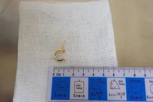  Bé gái 1 tuổi giật hoa tai bạn đang đeo nuốt vào bụng