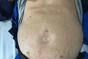 Bị bá bệnh vì chữa đau lưng 'tá lả'