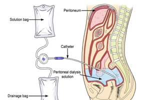 Bệnh thận mạn giai đoạn cuối không cần đến bệnh viện chạy thận