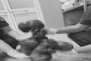 3 tiếng 'đánh vật' với khối u xơ gần 7kg dính chặt ổ bụng 