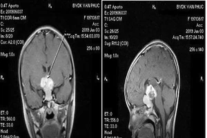 U não, coi chừng nhầm lẫn với nhiều bệnh thông thường