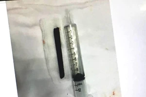 Bị đâm nửa chiếc đũa 9 cm vào mũi, sau 4 năm mới hay
