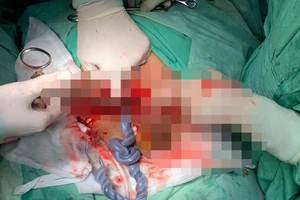 Báo động đỏ cứu bé gái thai suy vì dây rốn thắt nút