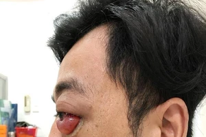 Chàng trai đột nhiên lồi mắt, suýt mù sau 2 năm bị té