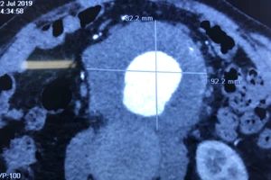 Đi khám đau lưng, tá hỏa phát hiện trong mình có 'bom nổ chậm'