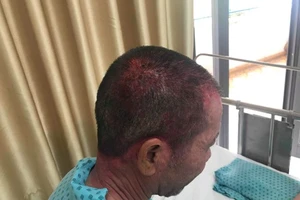 Nhập viện cấp cứu sau khi dùng thuốc nhuộm tóc