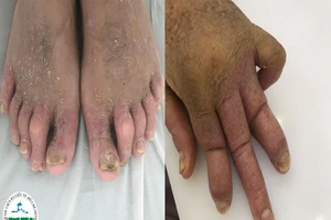 Biến dạng khớp vì tìm thầy lang chữa bệnh vảy nến