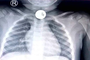 Trẻ tắc ống thực quản vì nuốt mặt dây chuyền