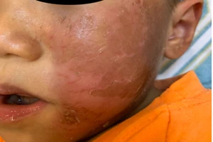 Bỏng rộp da sau khi đeo mặt nạ hóa trang Halloween