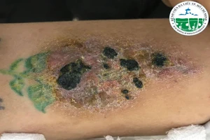 7 nguy cơ cần phải biết trước khi quyết định xăm mình