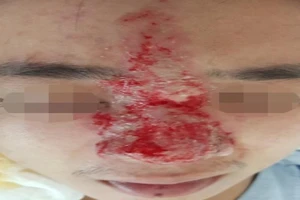 Thêm 1 người có nguy cơ mù mắt sau khi tiêm filler nâng mũi