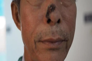 Báo động bệnh ung thư da ngày càng tăng cao