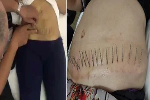 Dẹp cơ sở trị 'sẹo ác quỷ' không phép tại TP.HCM