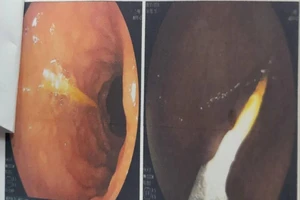 Bà đi pha sữa, bé 1 tuổi ngồi chơi nuốt tăm suýt thủng ruột