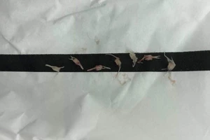 6 mảnh xương cá găm khắp nơi trong đường thở bé 1 tuổi