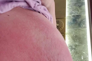 Dị ứng toàn thân sau khi thoa rượu gừng nghệ hạ thổ sau sinh