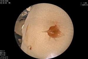 Bé 7 tháng tuổi hóc xương lươn gai sắc, tắc nghẽn phổi