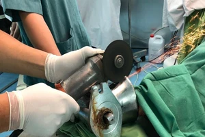 Bác sĩ cưa máy xay thịt giải cứu bàn tay cho bệnh nhân