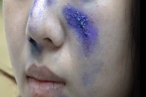 TP.HCM: Báo động bỏng, viêm da do kiến ba khoang 