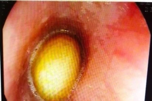 Bé 21 tháng tuổi suýt chết vì nghẹn hạt mít