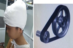 Bị lột toàn bộ mái tóc, bé gái phải trải qua 3 ca phẫu thuật