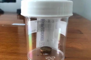 Nhét pin điện tử vào mũi, bé 4 tuổi bị axit hủy hoại hốc mũi