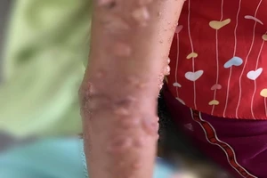 Bé gái nhập viện vì bỏng da nặng do tiếp xúc sứa biển 