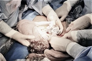 Cứu sống song thai với dây rốn xoắn lò xo, thắt nút nhiều lần