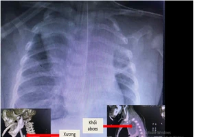 Bé trai nguy kịch vì mảnh xương lươn cắm chặt thực quản 5 ngày