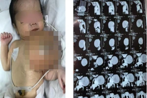 Bé trai mới sinh mang 'quả bóng khủng' trước ngực