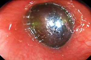 Nuốt viên sỏi hồ cá, bé trai 3 tuổi tắc thực quản