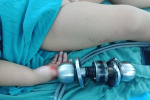 Cứu ngón tay bé trai 3 tuổi bị kẹt trong ổ khóa