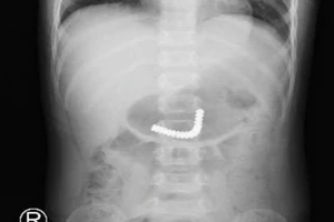 Cắt, nối ruột cho 2 bé trai nuốt 38 viên nam châm 