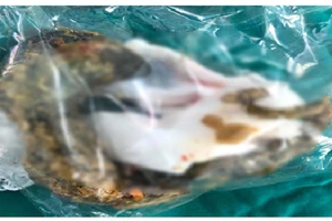 Khám đau bụng, tá hỏa phát hiện bé gái mắc búi tóc to ở ruột