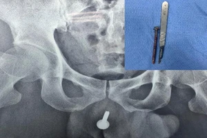 Đi cấp cứu vì bị bạn nhậu nhét đinh vít 6cm vào đường tiểu