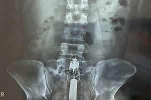 Giải cứu nam thanh niên bị kẹt dương vật giả trong trực tràng