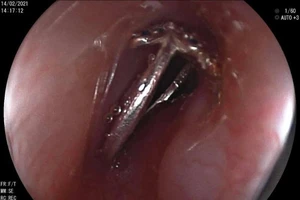 Bé gái 10 tuổi khóc nấc vì nghẹn chiếc nhẫn mới được tặng