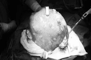 Đâm kim vào khối u hút máu ra ngoài, bị lở loét, hoại tử nặng