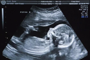 Kỳ lạ bé gái mang người anh em sinh đôi trong bụng