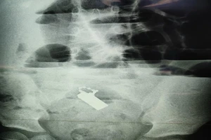 Bé trai thủng ruột, nhiễm trùng nặng vì 3 dị vật không ngờ