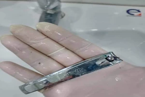 Thanh niên nuốt bấm móng tay phải đi cấp cứu 